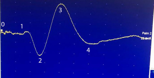 Figure 3 The SSR response wav form. 0–1: Horizontal line: onset latency(s). 2–3: Vertical line: peak to peak Amplitude (µV). 1–4: Horizontal line: total duration of SSR response(s).