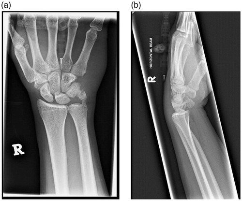 Figure 1. (a) X-ray (anteroposterior view) of the right hand, showing the displaced pisiform fracture. (b) X-ray (lateral view) of the right hand, showing the displaced pisiform fracture.