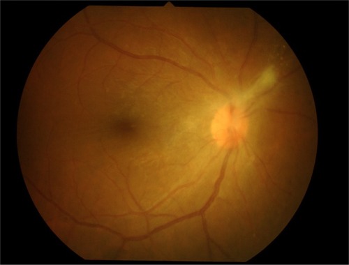 Figure 2 Intraoperative findings were dense vitritis, fibrous tissue on superior disk with diffuse periphery sclerotic vessels, and sheathing of both artery and vein.