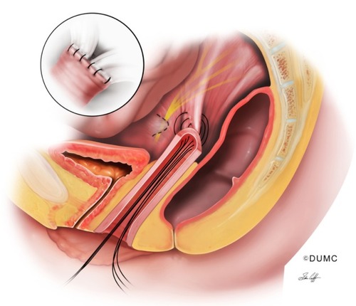 Figure 2 Uterosacral ligament suspension. Stitches are placed through an open vaginal cuff into the uterosacral ligament. Image depicts three stitches in the right uterosacral ligament, which are then brought through the vaginal cuff (if permanent stitches are used, they are placed through a partial-thickness segment of the vaginal cuff and are not brought into the vaginal cavity). The image also shows the course of the sacral nerve roots, which exit various sacral foramina and join to form the lumbosacral trunk. These nerves lie underneath the peritoneum, deep in the pelvis. Inset depicts view from inside the abdomen after stitches are tied down, where the vaginal cuff is affixed to bilateral uterosacral ligaments.