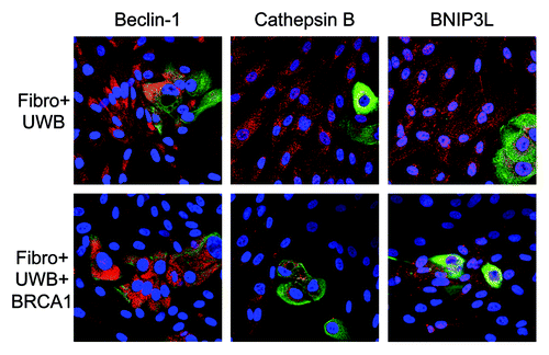 Figure 13. BRCA1-null ovarian cancer cells induce autophagy and mitophagy in adjacent fibroblasts: Rescue with wild-type BRCA1. BJ-1 fibroblasts were co-cultured with either UWB1.289 cells or UWB1.289+BRCA1 cells for 3 d. Cells were then fixed and immunostained with anti-Beclin-1, Cathepsin B or BNIP3L (red) and anti-K8–18 (green) antibodies. Co-culture of BJ-1 fibroblasts with UWB1.289 cells is shown in the top panels and the co-culture with UWB1.289+BRCA1 cells is shown in the bottom panels. Original magnification, 40x. Note that Beclin-1, Cathepsin B and BNIP3L are upregulated in fibroblasts co-cultured with UWB1.289 cells, as compared with co-culture with UWB1.289+BRCA1 cells.