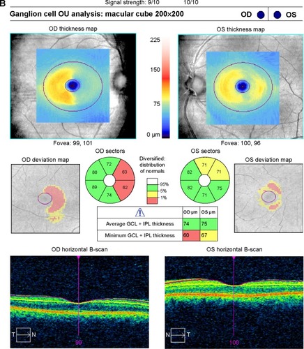 Figure 2 (A) SD-OCT RNFL for patient 1 showing normal thickness without a relative difference in thickness between affected and unaffected fibers as well as an example of how the calculations were performed. (B) SD-OCT ganglion cell complex for patient 1 showing relative thinning in the nasal macula of the right eye and temporal macula of the left eye corresponding to the right hemianopsia.