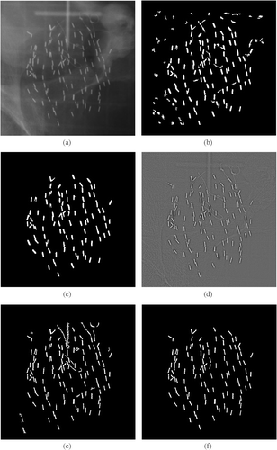 Figure 4. (a) Original radiograph of a patient implant. (b) Automatic segmentation result using morphological techniques without size analysis. (c) Result from (b) after size analysis and manual editing. (d) Filtered image using the predefined point spread function (PSF). (e) Segmentation result by interactive thresholding of both (a) and (d). (f) Result after size analysis and manual editing.