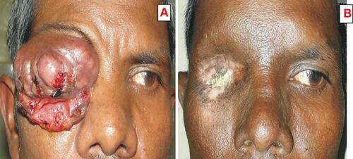 Figure 2 (A) Clinical photograph of a 48 years old male patient having right lower eyelid squamous cell carcinoma with orbital invasion before chemotherapy. (B) After 5 cycles of neoadjuvant chemotherapy and 3 cycles of external beam radiation.