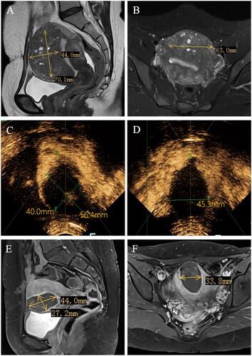 Figure 1. Magnetic resonance imaging of the uterus before HIFU treatment (A, B) and 3 months after HIFU treatment (E, F). Contrast-enhanced ultrasound immediately after HIFU treatment (C, D). HIFU: high-intensity focused ultrasound.