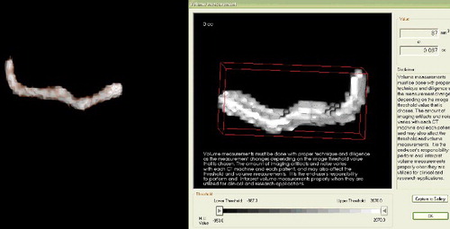 Figure 4. Volume of mandibular canal and anterior loop measured three-dimensionally (using 3D Invivo software).