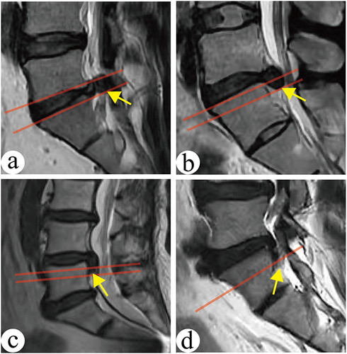 Figure 2 (a) Nucleus pulposus migration in zone 0. The red line is the extension of the upper and lower endplates, and the yellow arrow points to the most distal end of the nucleus pulposus; (b) Nucleus pulposus migration in zone 3, the red line is the lower endplate extension and the midpoint extension of the pedicle, the yellow arrow points to the most distal part of the nucleus pulposus; (c) Nucleus medullaris migrating in zone 4, red line is the midpoint of the pedicle root and the lower endplate extension, yellow arrow points to the most distal end of the nucleus medullaris; (d) Nucleus pulposus migration in zone 6, red line is the extension of the inferior border of the pedicle root, yellow arrow points to the most distal end of the nucleus pulposus.