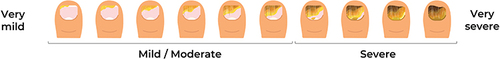 Figure 1 Toenail onychomycosis severity visual aid.