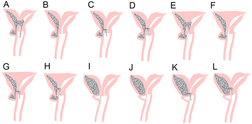 Figure 2 Anatomical illustrations of the utero-cervical-vaginal anatomy in Type II UGTOIRA syndrome (cervicovaginal obstruction).Partial bicorporeal uterus, septate cervix with unilateral cervical dysplasia, and high oblique vaginal septum, with the communication between the left and right lower portions of the uterine cavity (A); partial bicorporeal septate uterus, septate cervix with unilateral cervical dysplasia, and high oblique vaginal septum, without communication (B), with a fistula in the cervix septum (C), with communication between both internal orifices of the cervix (D); partial septate uterus, septate cervix with unilateral cervical dysplasia, and high oblique vaginal septum, with the communication between the left and right lower portions of the uterine cavity (E); complete septate uterus, septate cervix with unilateral cervical dysplasia, and high oblique vaginal septum, without communication (F), with a fistula in the cervix septum (G), with communication of both internal orifices of cervix (H);complete bicorporeal uterus, double cervix with unilateral obliterated cervical os, and high oblique vaginal septum, without communication (I); partial bicorporeal septate uterus, septate cervix with unilateral obliterated cervical os, and high OVS, without communication (J), with a fistula in the cervical septum (K), with communication of both internal orifices of cervix (L).