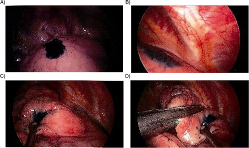 Fig. 1 (A, B) Initial thoracoscopic view; (C, D) stained portion being resected during VATS.