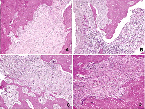 Figure 5. Histopathological view showing the severity of inflammation among the groups: (A) control, normal appearance, (B and C) Groups I and II, focal inflammation areas, neutrophils and foamy histiocytes surrounding the extraction sites, severe inflammation, (D) Group III, similar with control group, mild inflammation (PAS + HL 200×).