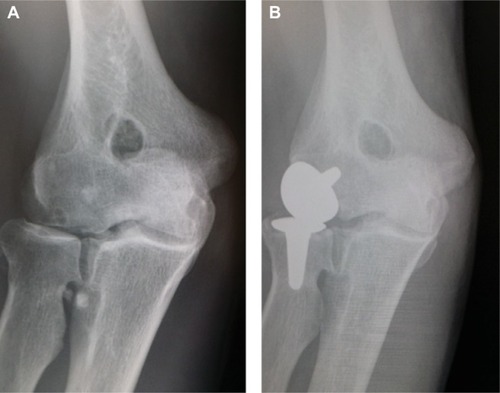Figure 13 (A) AP radiograph of an osteoarthritic elbow with a “congenital hole” between the olecranon and the coronoid fossae, similar to that which Outerbridge reported to Kashiwagi which led to the development of the Outerbridge–Kashiwagi procedure for the removal of olecranon and coronoid osteophytes (“ulnohumeral arthroplasty”). (B) Postoperative AP radiograph following arthrolysis which confirmed degenerative changes confined to the radiocapitellar joint surfaces; the ulnohumeral joint surfaces were well preserved – a lateral resurfacing elbow arthroplasty has been inserted.
