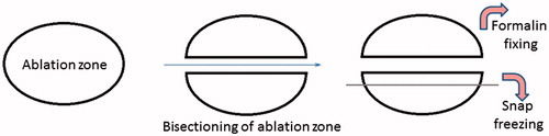 Figure 3. Macroscopy of microwave ablation zone. Macroscopic appearances of the extension zone along vessels in three different ablation zones. These ablation zones demonstrate the zonal anatomy of a central dark zone (carbonised tissue), surrounding white zone (non-carbonised thermal coagulation) and an outer red zone (boundary of the ablation zone).