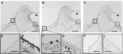 Figure 3 (A–I) Immunohistochemical analysis of the middle-ear of the recipients after mucosal tissue elimination before transplantation. (A, D and E) Anti-pancytokeratin; (B, F and G) anti-vimentin; (C, H and I) normal mouse immunoglobulin G. In the middle-ear lesion, vimentin-positive cells were detected (arrows in B and F), and only a few pancytokeratin-positive cells were present (A and D). In the external ear, pancytokeratin-positive cells were detected in the epithelial lesion (arrows in A and E), while vimentin-positive cells were detected in the subepithelial lesion (arrows in B and G). No staining was detected in sections reacted with normal mouse immunoglobulin G instead of the primary antibody (C–I).Note: Arrowheads, tympanic membrane; arrows, positive cells; scale bars 100 μm (A–C), 50 μm (D–I).