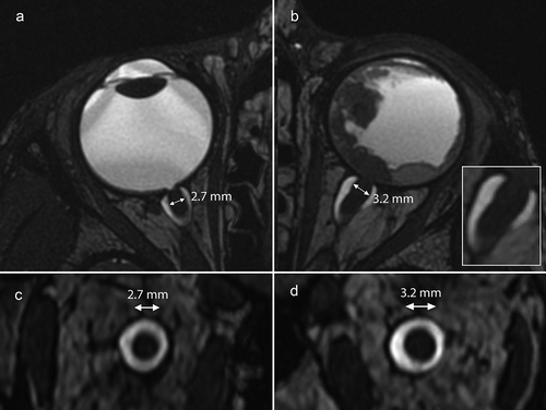 Figure 3. Maximum diameters on axial and oblique coronal reconstructions of FIESTA images (pixel size is 0.27 mm and slice thickness 0.6 mm) of the distal optic nerve of the unaffected OD (a and c) and affected OS (b and d).