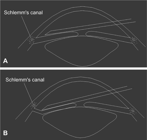 Figure 1 (A) A 26-gauge needle is inserted into the anterior chamber angle in front of the iris before peripheral anterior synechiae dissection. (B) The surgeon pushed the iris root backward to drag it down from the angle wall and trabecular meshwork surface.