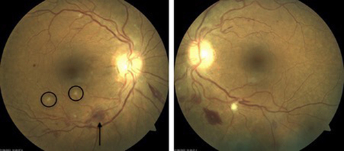 Figure 2 Fundus photography of the right and left eyes demonstrates bilateral venous dilation retinal hemorrhages (labelled) and cotton wool spots (circled).