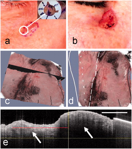 Figure 4. Clinical images of a nodular BCC on the cheek of patient 2 before (a) and after (b) MMS. The dermoscopy image is inset in (a), with the fiducial marker placed across a segment of the pre-surgical border. (c) The selected OCT plane that straddles the clinical border is shown in black on the 3D rendered OCT-dermoscopy image. (d) The pre-surgical border, OCT-defined margin and final MMS defect are superimposed on the 3D rendered image following the line style convention used in Figure 3. (e) The OCT image corresponding to the selected plane shows a BCC cell nest (left arrow) extending beyond the pre-surgical margin (vertical line). A large cell nest can also be seen largely within the pre-surgical margin (right arrow). The red line indicates the infiltration as assessed from this image. The OCT image scale bar corresponds to 1 mm.