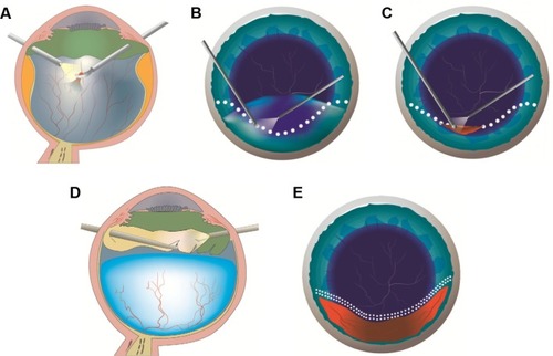 Figure 1 Procedure of dashed line relaxing retinotomy.
