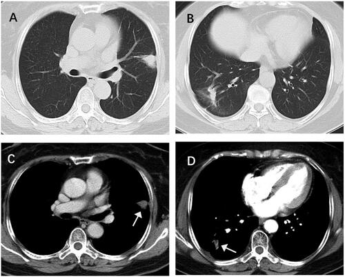 Figure 5. Female patient 66, postoperative rectal cancer, CT review 1 month after ablation, the ablation area showed triangular and cord-like consolidation without significant enhancement (arrow).