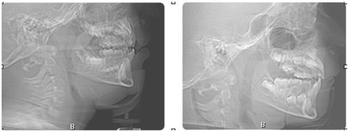 Figure 9 Patient above is a five-year old with Pierre Robin Sequence, suffering from OSA. Orthotropic® treatment to advance both jaws resulted in complete elimination of OSA.