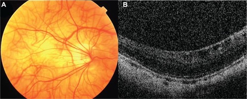 Figure 2 Three months after onset. The patient’s best-corrected visual acuity has not improved.