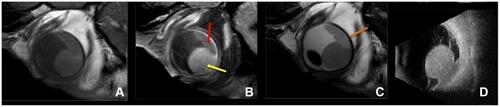 Figure 3 Magnetic resonance (MR) images and ultrasound of a uveal melanoma (UM) with retinal detachment. Sagittal T1 (A), enhanced T1 with fat signal suppression (B) and T2 (C). Ultrasound (US) (D). Notice that the UM enhances (yellow arrow), while the retinal detachment does not enhance (red arrow) and that the outer limit of the sclera is well identified (orange arrow). In comparison with US, the possibility of acquiring multiple sequences and the high soft tissue contrast and high spatial resolution of MRI allow for a better differentiation between tumour and retinal detachment, for a better tumour characterization and better identification of the sclera.