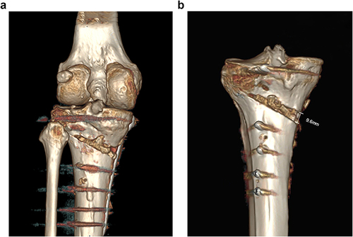 Figure 1 Display of osteotomy area in anterior and posterior position by three-dimensional CT after operation. (a) Postoperative CT showed that the osteotomy space was filled with allograft bone. (b) The opening width of the osteotomy gap was < 10mm confirmed by postoperative CT measurement.