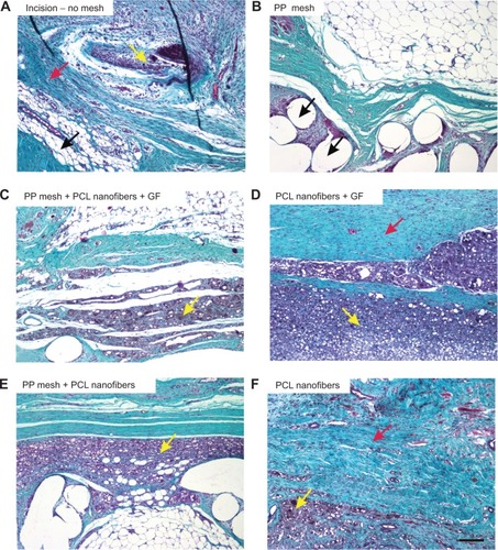 Figure 10A–F Collagen, adipose tissue, and granulomatous infiltration in the scaffolds under study.Notes: In samples without any mesh (A), the incision was healing with a mixture of collagen (black arrow), adipose connective tissue (red arrow), and inflammatory infiltrate (yellow arrow). Samples with PP mesh (B) had a high fraction of adipose tissue, but the spaces showing the dissolved mesh (black arrows) were surrounded by only a few inflammatory cells. Remnants of the nanofibers (C–F) were surrounded by granulomatous leukocyte-rich connective tissue (yellow arrows). The highest fraction of collagen (red arrow) was in samples of PCL nanofibers with adhered GF (D), followed by samples with no mesh (A) and by samples of PCL nanofibers (F). Low fractions of adipose tissue were found in samples of PCL nanofibers with adhered GF (D), samples with no mesh (A), and in samples of PCL nanofibers (F). Verhoeff’s hematoxylin and green trichrome staining. Magnification 100×, scale bar 200 μm.Abbreviations: PP, polypropylene; PCL, poly-ε-caprolactone; GF, growth factor.