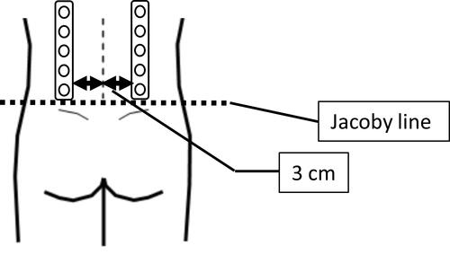 Figure 2 The approximate position of the EMG grid. The EMG electrode grid was placed 3 cm lateral to the lumbar spinous process on the bilateral erector spinae.