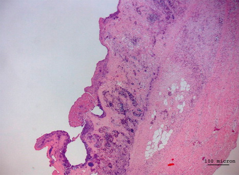 Figure 4. Section of intestine showing uniform diffuse coagulation necrosis of the mucosa, diffuse lymphoplasmacytic infiltration and bacterial aggregates; bar = 100 µm.