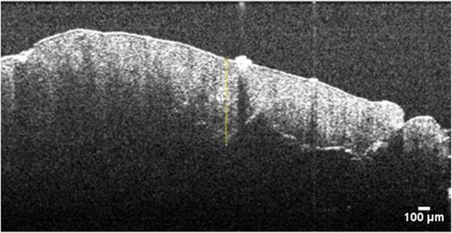 Figure 1 OCT cross-sectional image sample with linear shape measuring segment.
