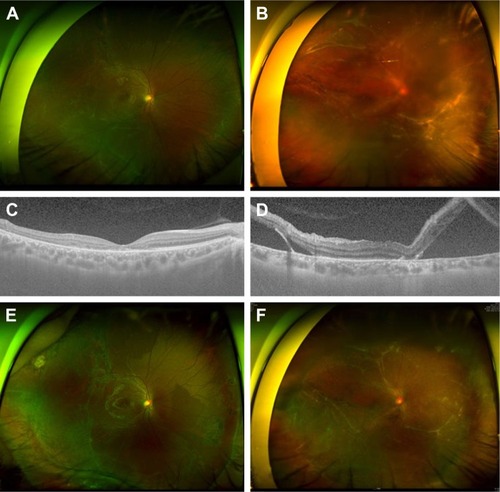 Figure 3 Chronic rhegmatogenous retinal detachment with subretinal strand.