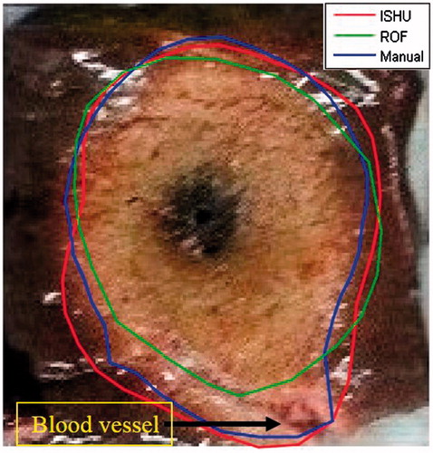 Figure 9. Example of the “chimney effect” phenomenon. As can be noted the ROF algorithm ignores the regions of ablation that were caused by this phenomenon while the ISHU algorithm captures them.