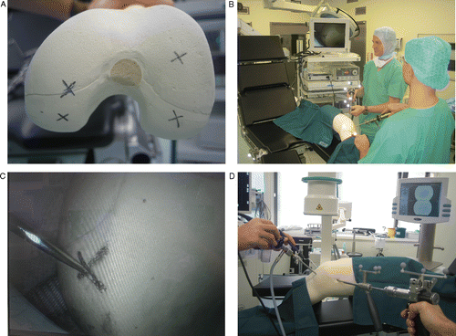 Figure 1. Operating room set-up. A: Markings on the distal femur representing osteochondral lesions. B: Arthroscopy is used to determine the locations of the markings with a (navigated) pointer. C and D: Set-up for arthroscopically assisted retrograde drilling controlled by 2D fluoroscopy (group 1) or the Fluoro Free navigation technique (group 2).