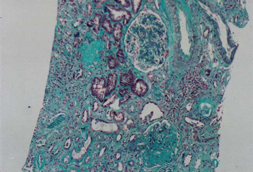 Figure 2.  Light microscopic appearance of a renal biopsy showing intense fibrosis. Masson Trichrome staining × 200.