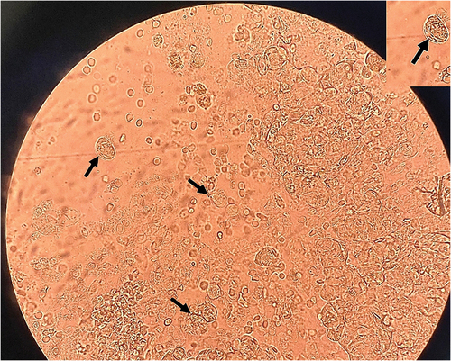 Figure 2. Lophomonas (black arrow) detected in the bronchoalveolar lavage fluid by microscopic observation: direct smear (×100).