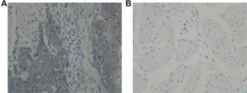 Figure 1 IHC staining of CST1 in ESCC tissue and paracancerous tissue (×400). (A) Strong expression of CST1 with 3+ staining in ESCC tissue. (B) Negative expression of CST1 in paracancerous tissue.