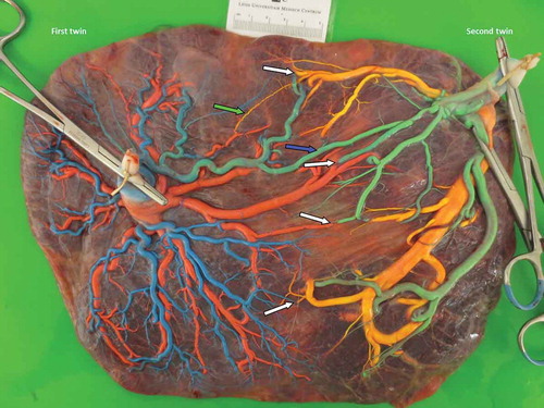 Figure 1. (Full color available online) Uncomplicated monochorionic twin placenta after color dye injection showing large vascular anastomoses. Arteries are injected with blue and green dye and veins are injected with pink and yellow dye. Arterio-venous anastomoses are indicated with white arrows, an arterio-arterial anastomosis is indicated with a blue arrow and a veno-venous anastomosis is indicated with a green arrow.