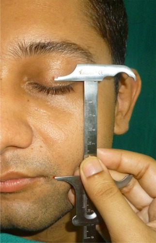 Figure 5 Measurement of distance between rima oris and pupil of eye.