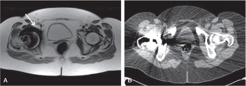 Figure 1. Patient 6. Type-2a lesion (indicated by arrow) classified on MARS MRI scan (A) but lesion cannot be seen on the equivalent CT scan (B). The high attenuation coefficient of the metal implant on CT has led to significant scatter obscuring much of the periprosthetic anatomy, further compounded by a less clear distinction of soft tissues with this modality.