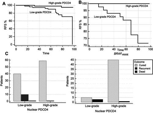 Figure 4 (A–C) Nuclear loss of PDCD4 expression correlates with poor outcome. Kaplan–Meier curve for RFS in PTC samples with low-grade and high-grade PDCD4 expression (A). Kaplan–Meier curve for RFS in BRAF V600E samples with low-grade and high-grade PDCD4 expression (B). Low-grade PDCD4 results correlated with recurrent/persisted disease or death at the end of the follow-up (C). BRAF wild type patients with high-grade PDCD4 nuclear expression resulted significantly associated with better outcome (cured disease) (D).Abbreviations: PDCD4, programmed cell death 4; PTC, papillary thyroid cancer; RFS, recurrence-free survival rate.