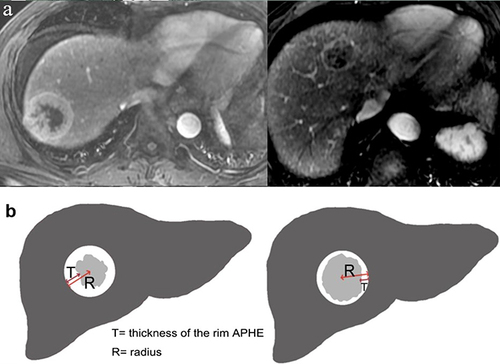 Figure 2 Rim hyperenhancement patterns on AP image and the modified measurement criterion of rim APHE. (a) Rim hyperenhancement patterns on AP image, thick-rim(left) and thin-rim(right). (b) the modified measurement criterion of rim APHE. Hepatic observations with rim APHE (spatially defined subtype of APHE in which arterial phase enhancement is most pronounced in the periphery) were divided into two categories, thick-rim (30–70%) and thin-rim APHE (< 30%). The thickness measurement of the rim APHE compared with the tumor radius is T/R=30%-70%, classified as thick-rim APHE (left). The thickness measurement of the rim APHE compared with the tumor radius is T/R<30%, classified as thin-rim APHE(right).