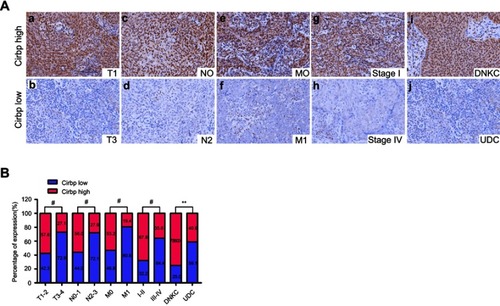 Figure 2 Cirbp downregulation was associated with the tumor malignant progression in NPC patients. (A) Representative pictures of Cirbp expression in nasopharyngeal carcinoma (NPC) clinical biopsies of different TNM stages, clinical stage and histological type. High expression of Cirbp was detected in the T1 (a), N0 (c), M0 (e) and I (g) stages, and differentiated nonkeratinizing carcinoma (DNKC)(i) of NPC biopsies, while low expression of Cirbp was observed in the T3 (b), N2 (d), M1 (f) and IV (h) stages, and undifferentiated carcinoma (UDC)(j) of tumor. (B) The number and percentage of low and high expression of Cirbp based on different clinicopathological features. **P<0.01 and #P<0.001. 