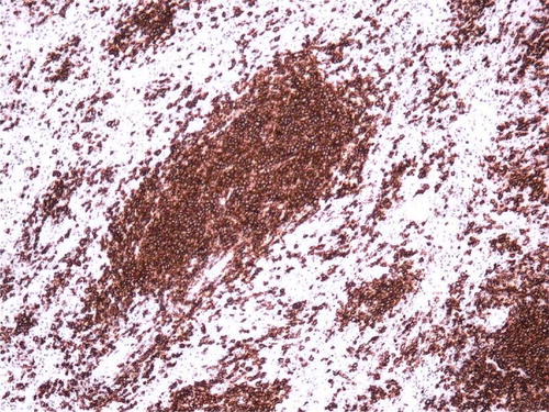 Figure 3.  CD 20 immunostain demonstrating the lymphocytes to be B-cells.