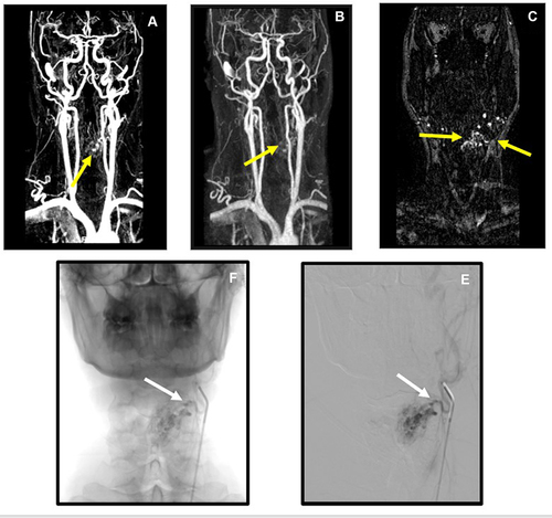 Figure 3 Arteriovenous malformation (AVM) of the left pre-epiglottic and paraglottic space. (A–C) Magnetic Resonance Angiography (MRA) images, with T2 3D fat-saturated sequences, show a AVM of the left paraglottic space at the level of the false vocal cord (yellow arrows). (D and E) Panoramic (D) and selective (E) angiography show that the AVM is fed by the left superior thyroid artery (white arrows).