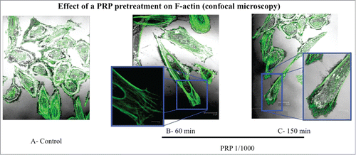 Figure 5. Effect of a PRP treatment on rearrangement of actin microfilaments. Fluorescence images of phalloidin stained SaOS-2 cells treated with culture media (A), PRP 1/1000 for 60 minutes (B) and PRP 1/1000 for 150 minutes (C). In the details (B and C) a lamellipodium rich in actin microspikes. Images in confocal microscopy at 63× magnification, zoom 2×.