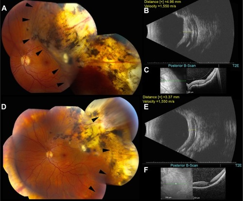 Figure 1 Color fundus, B-scan echography, and OCT images of the left eye.