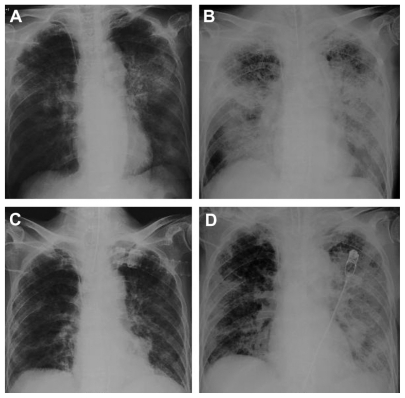 Figure 1 Chest radiographs. (A) Onset of the first transfusion-related acute lung injury episode on hospital day 3. (B) At the initiation of mechanical ventilation on day 9. (C) A clear chest radiograph on day 23. (D) Onset of the second first transfusion-related acute lung injury episode on hospital day 34.
