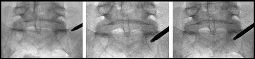 Figure 12 AP view showing progression of the trocar from the lateral to medial S1 pedicle border while simultaneously moving towards the posterior aspect of the S1 vertebral body. As the trocar is advanced it is important that the stylet tip not pass the medial border of the S1 pedicle in the AP view until it breaches the posterior vertebral body wall in the lateral view.